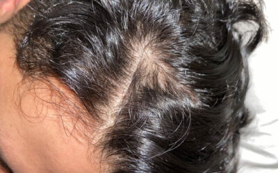 What Should I Know Before Laser Hair Removal in Temecula?