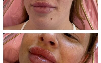 What to Look for When Searching for the Best Lip Injections Near Me