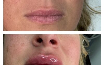 Top 7 Myths About Laser Vein Treatment Debunked