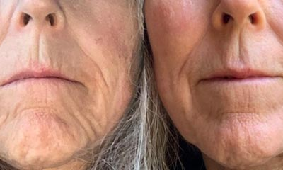 Are You Looking for Synergy Laser & Skin Institute? Best Lip Injections and CO2 Laser Resurfacing Near Me